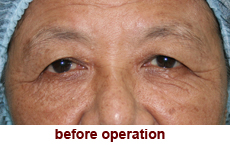 plastic-surgery-blepharoplasty